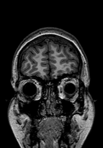 Cerebral arteriovenous malformation at posterior body of corpus callosum (Radiopaedia 74111-84925 Coronal T1 21).jpg