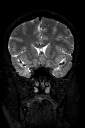 Cerebral arteriovenous malformation at posterior body of corpus callosum (Radiopaedia 74111-84925 Coronal T2 58).jpg