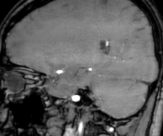 Cerebral arteriovenous malformation at posterior body of corpus callosum (Radiopaedia 74111-84925 J 122).jpg