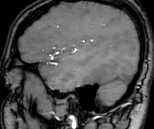 File:Cerebral arteriovenous malformation at posterior body of corpus callosum (Radiopaedia 74111-84925 J 332).jpg