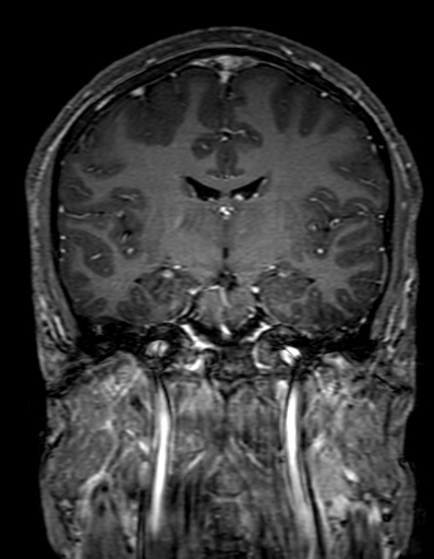 Cerebral arteriovenous malformation at posterior body of corpus callosum (Radiopaedia 74111-84925 K 182).jpg