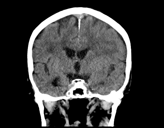 Cerebral arteriovenous malformation with lobar hemorrhage (Radiopaedia 44725-48510 Coronal non-contrast 25).png