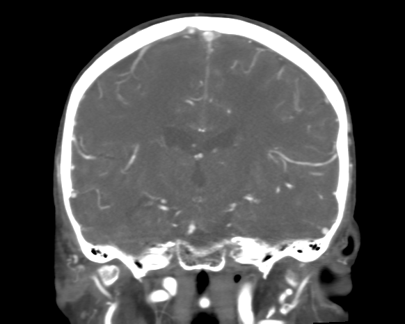 Cerebral arteriovenous malformation with lobar hemorrhage (Radiopaedia 44725-48511 A 32).png