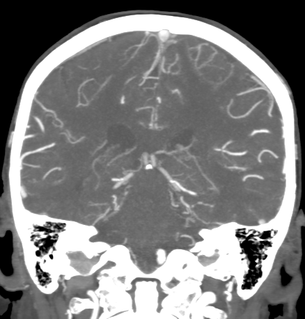 Cerebral arteriovenous malformation with lobar hemorrhage (Radiopaedia 44725-48511 B 36).png