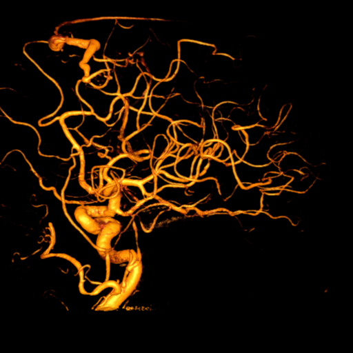 Cerebral arteriovenous malformation with lobar hemorrhage (Radiopaedia 44725-48513 Lateral 27).png