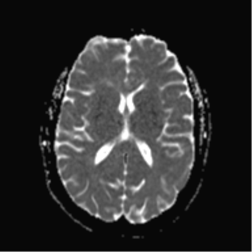 File:Cerebral cavernoma and development venous anomaly (Radiopaedia 37603-39482 Axial ADC 13).png