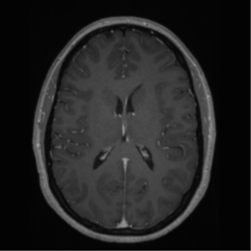 File:Cerebral cavernoma and development venous anomaly (Radiopaedia 37603-39482 Axial T1 C+ 44).png