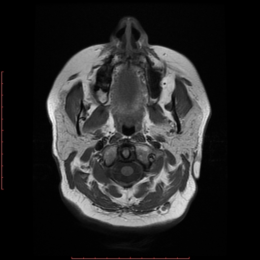 File:Cerebral cavernous malformation (Radiopaedia 26177-26306 Axial T1 1).jpg