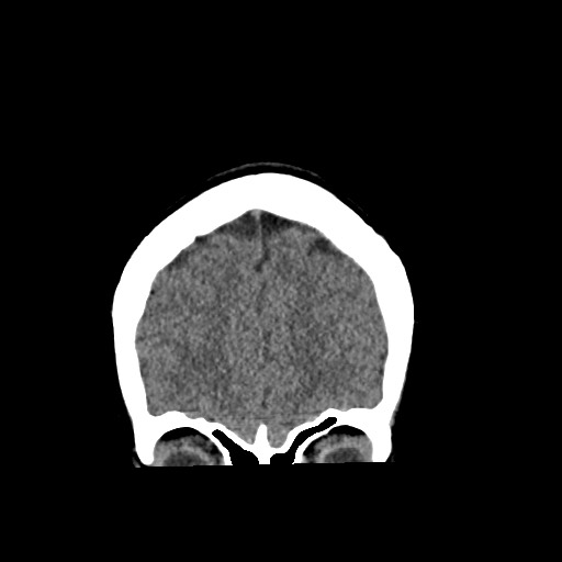 Cerebral cavernous venous malformation (Radiopaedia 70008-80022 non-contrast 13).jpg