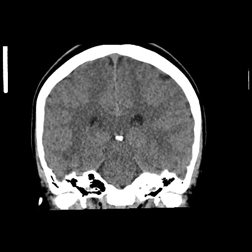 Cerebral cavernous venous malformation (Radiopaedia 70008-80022 non-contrast 42).jpg