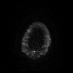 Cerebral cavernous venous malformation (Zabramski type II) (Radiopaedia 85511-101198 Axial DWI 97).jpg