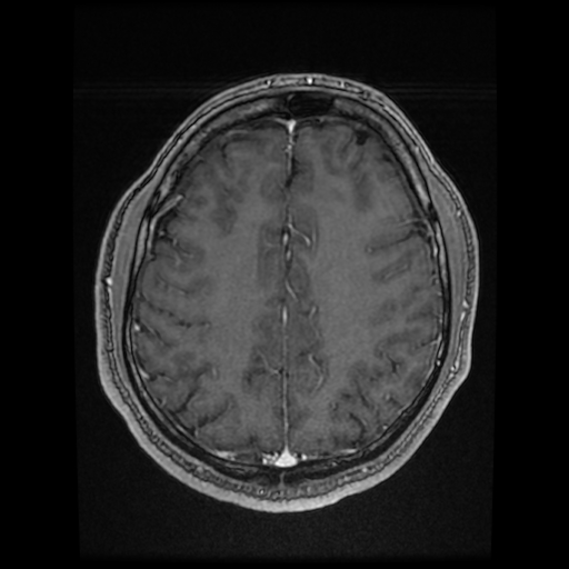 Cerebral cavernous venous malformation (Zabramski type II) (Radiopaedia 85511-101198 Axial T1 C+ fat sat 29).jpg