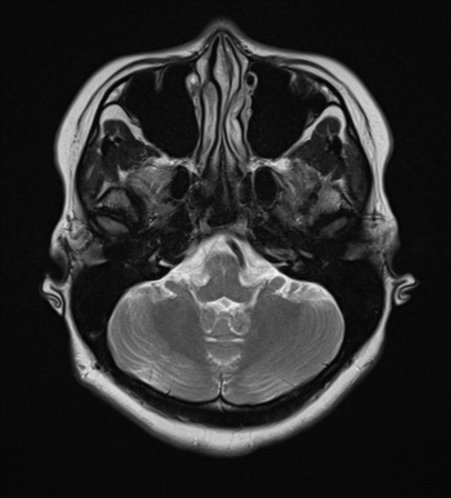 File:Cerebral cavernous venous malformations (Radiopaedia 48117-52946 Axial T2 5).png