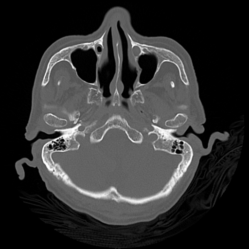 File:Cerebral contusions, subarachnoid hemorrhage and subdural hygromas (Radiopaedia 55399-61827 Axial bone window 10).png