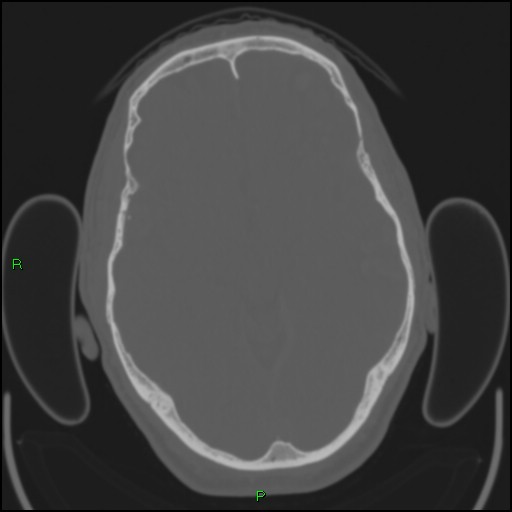Cerebral contusions (Radiopaedia 33868-35039 Axial bone window 87).jpg