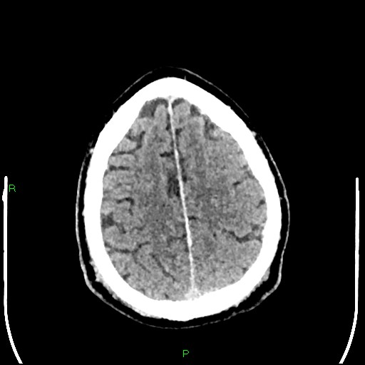 Cerebral contusions (Radiopaedia 33868-35039 Axial non-contrast 176).jpg