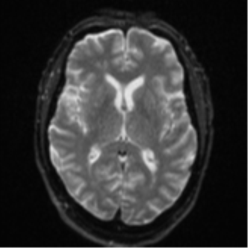 Cerebral embolic infarcts (embolic shower) (Radiopaedia 57395-64342 Axial DWI 19).png