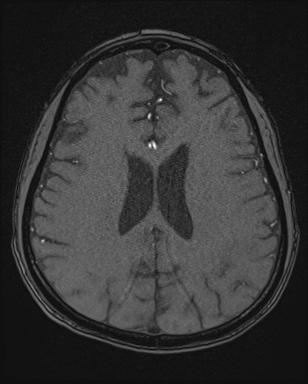 Cerebral embolic infarcts (embolic shower) (Radiopaedia 72391-82921 Axial MRA 130).jpg