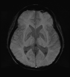 Cerebral embolic infarcts (embolic shower) (Radiopaedia 72391-82921 Axial SWI 37).jpg