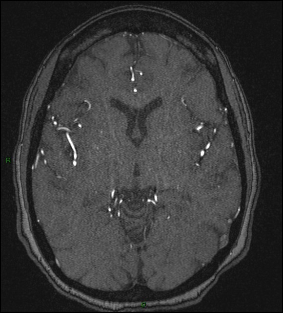 Cerebral fat embolism (Radiopaedia 35022-36525 Axial TOF 101).jpg