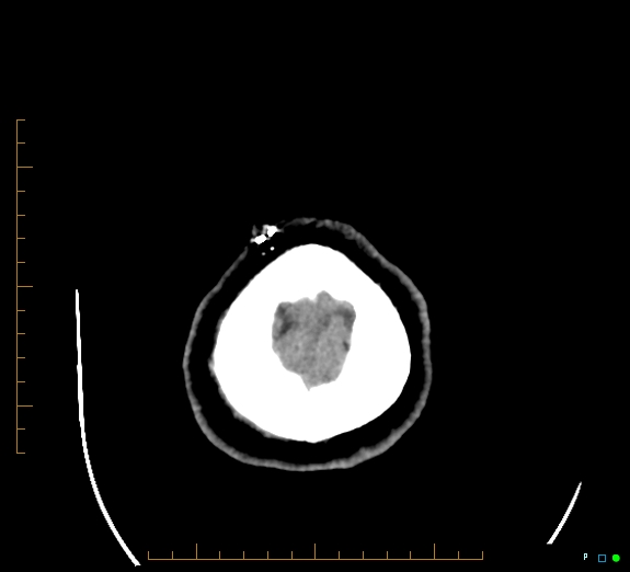 Cerebral fat embolism (Radiopaedia 85521-101220 Axial non-contrast 57).jpg