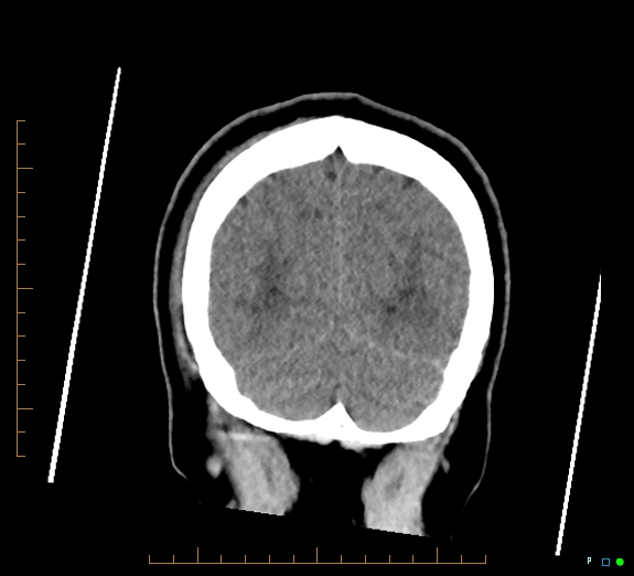 Cerebral fat embolism (Radiopaedia 85521-101220 Coronal non-contrast 52).jpg