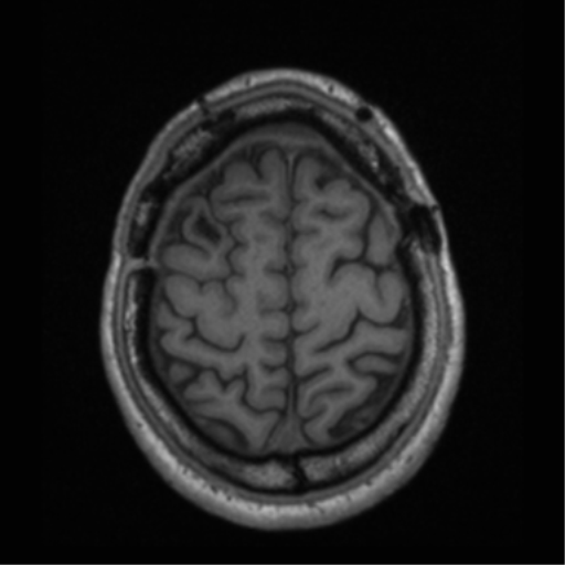Cerebral hemorrhagic contusions- temporal evolution (Radiopaedia 40224-42757 Axial T1 65).png