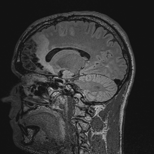 File:Cerebral hemorrhagic contusions- temporal evolution (Radiopaedia 40224-42757 Sagittal T1 49).png