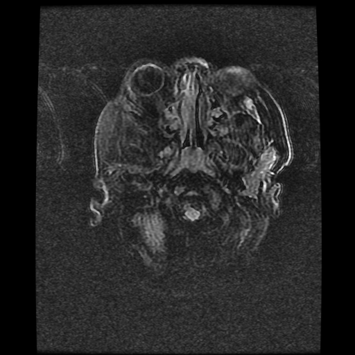 File:Cerebral manifestations of mucopolysaccharidosis type I (Radiopaedia 59171-66487 Axial FLAIR 1).jpg