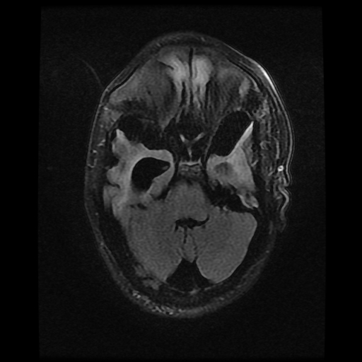 File:Cerebral manifestations of mucopolysaccharidosis type I (Radiopaedia 59171-66487 Axial FLAIR 5).jpg