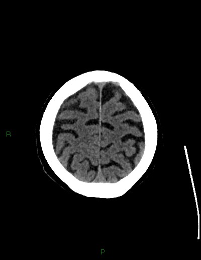 Cerebral metastases - ependymal and parenchymal (Radiopaedia 79877-93131 Axial non-contrast 68).jpg
