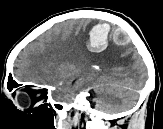 Cerebral metastases - testicular choriocarcinoma (Radiopaedia 84486-99855 F 22).jpg