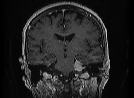 File:Cerebral metastases from lung cancer with amyloid angiopathy and cerebellopontine angle meningioma (Radiopaedia 74306-85191 Coronal T1 C+ 31).jpg
