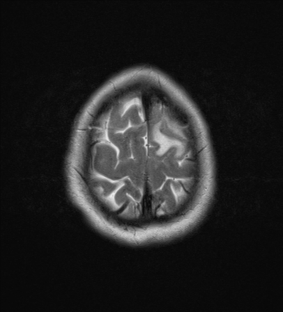 File:Cerebral metastases mimicking abscesses (Radiopaedia 45841-50131 Axial T2 26).png