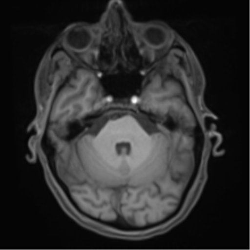 File:Cerebral metastasis - melanoma (Radiopaedia 54718-60954 Axial T1 16).png
