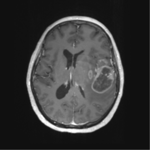 Cerebral metastasis mimicking glioblastoma (Radiopaedia 69155-78937 Axial T1 C+ 38).png