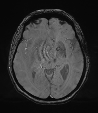 File:Cerebral metastasis to basal ganglia (Radiopaedia 81568-95413 Axial SWI magnitude 38).png