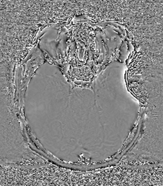 Cerebral metastasis to basal ganglia (Radiopaedia 81568-95413 Axial SWI phase 28).png