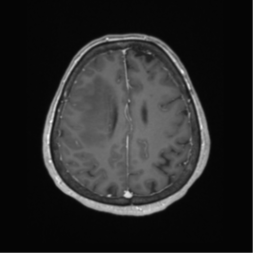 Cerebral metastasis to basal ganglia (Radiopaedia 81568-95413 Axial T1 C+ 54).png