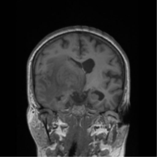 File:Cerebral metastasis to basal ganglia (Radiopaedia 81568-95413 Coronal T1 29).png