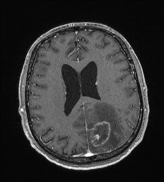File:Cerebral toxoplasmosis (Radiopaedia 43956-47461 Axial T1 C+ 48).jpg