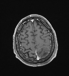 Cerebral toxoplasmosis (Radiopaedia 43956-47461 Axial T1 C+ 65).jpg