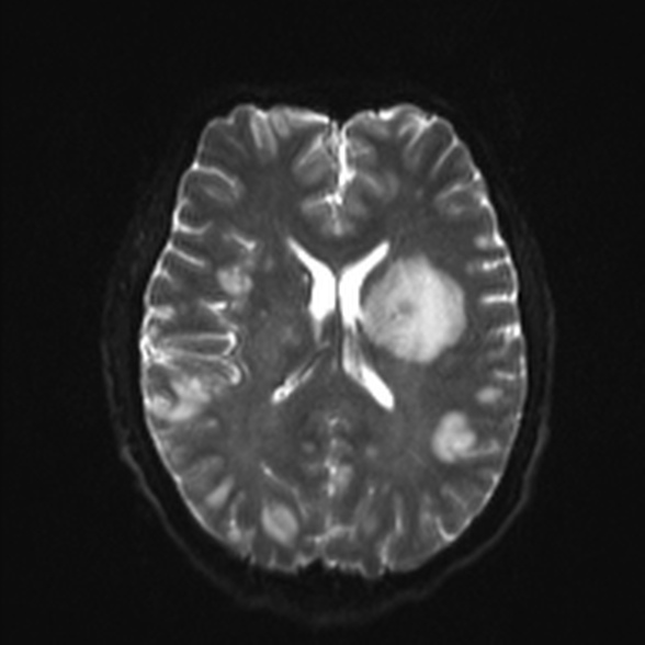 Cerebral toxoplasmosis (Radiopaedia 53993-60132 Axial DWI 16).jpg