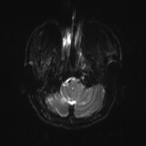Cerebral toxoplasmosis (Radiopaedia 53993-60132 Axial DWI 3).jpg