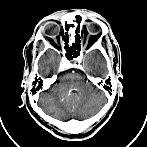 Cerebral venous angioma (Radiopaedia 69959-79977 B 14).jpg