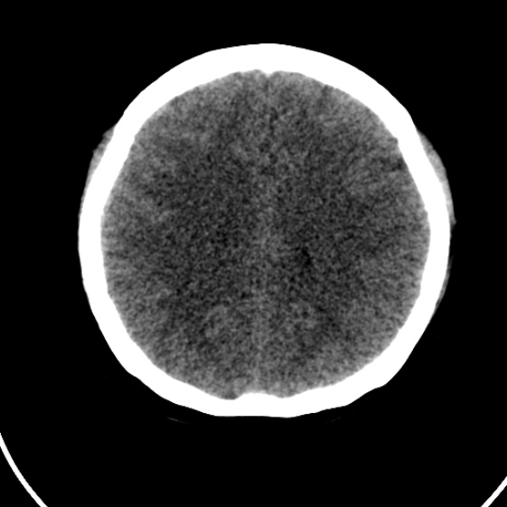 File:Cerebral venous hemorrhagic infarct from venous sinus thrombosis (Radiopaedia 55433-61879 Axial non-contrast 16).jpg