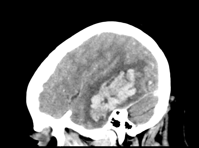Cerebral venous hemorrhagic infarction (Radiopaedia 57576-64538 Sagittal C+ 13).png