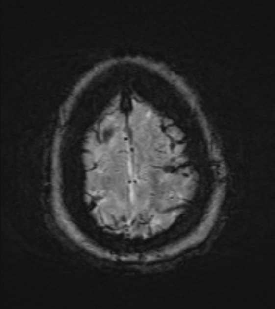 Cerebral venous infarct (Radiopaedia 53627-59685 Axial SWI 51).jpg