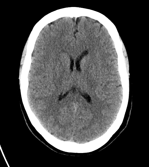 File:Cerebral venous infarct related to dural venous sinus thromboses (Radiopaedia 35292-36804 Axial non-contrast 17).png