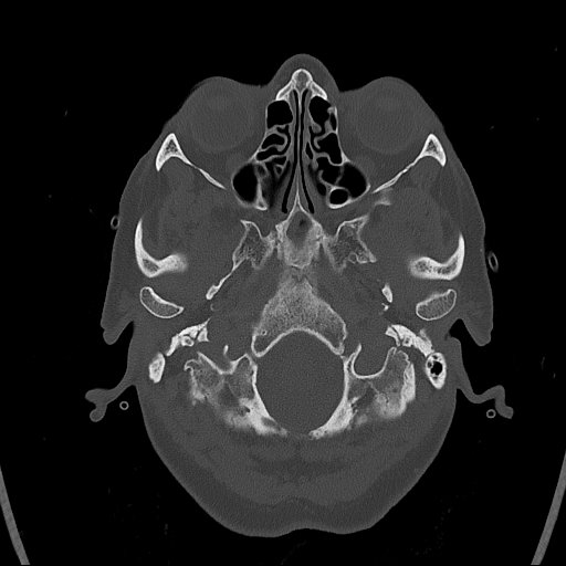 Cerebral venous infarction with hemorrhage (Radiopaedia 65343-74381 Axial bone window 7).jpg